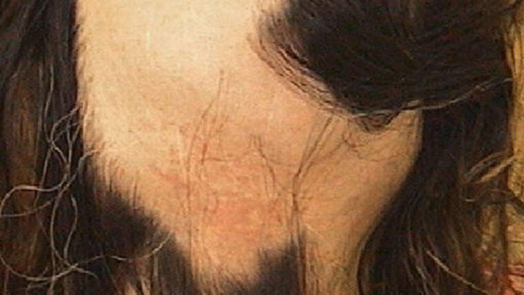 Trattamento della alopecia areata totale o universale