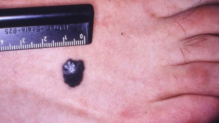 Melanoma